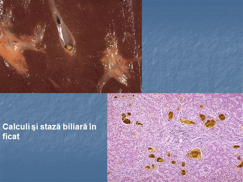 Calculi şi stază biliară în ficat